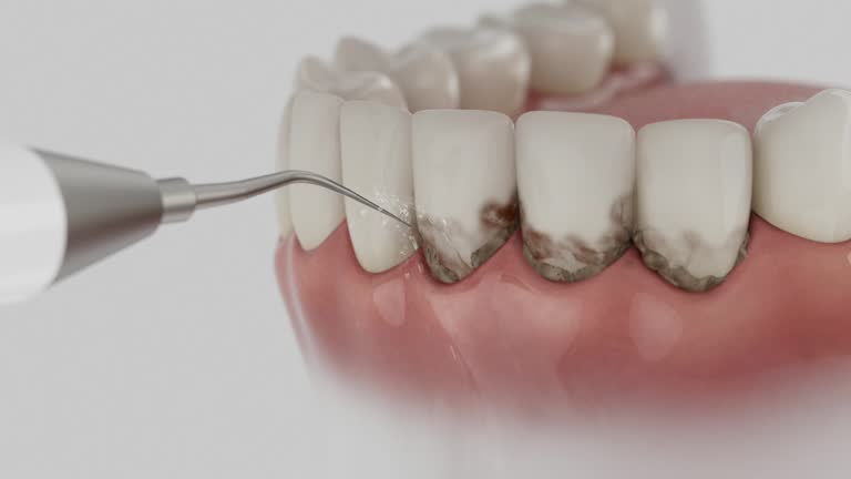 Trusted Wisdom Tooth Removal service in Neillsville, WI - Dentist Open Now
